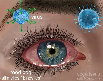 Allergische conjunctivitis met chemose en duidelijke conjunctivale zwelling. Bron: oogartsen.nl