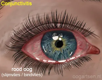 Infectieuze conjunctivitis met purulente afscheiding op de ooglidrand. Bron: oogartsen.nl