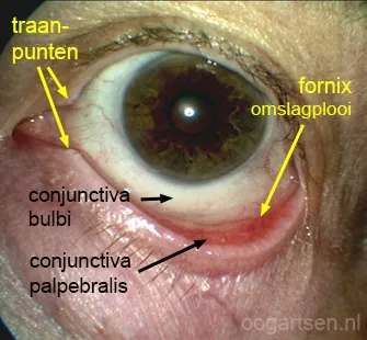 Sterke roodheid van de palpebrale conjunctiva — keer altijd het bovenooglid om bij rood oog z.o.o. Bron: oogartsen.nl