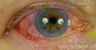Rood oog door conjunctivitis met diffuse oppervlakkige (conjunctivale) roodheid. Bron: oogartsen.nl