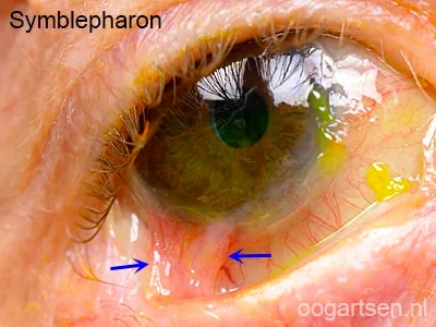 Symblepharon — verkleving tussen ooglid en oogbol bij cicatricieel beloop (zeldzaam, bv. Stevens-Johnson, pemfigoïd). Bron: oogartsen.nl