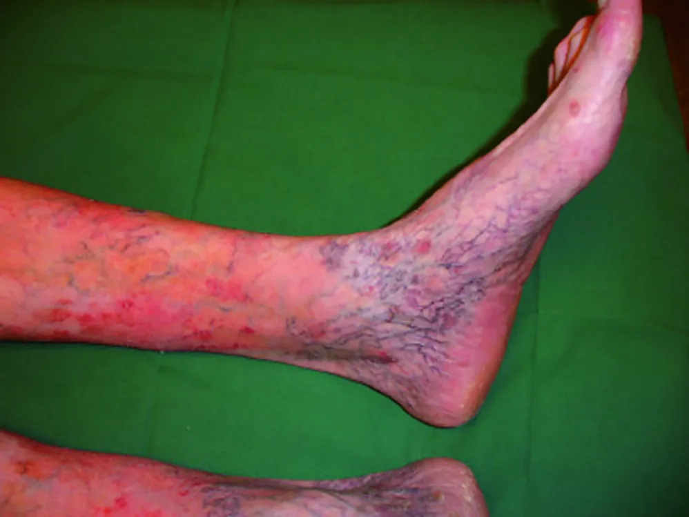 Ankle flare — uitgezette kleine venen mediaal en lateraal aan de enkel