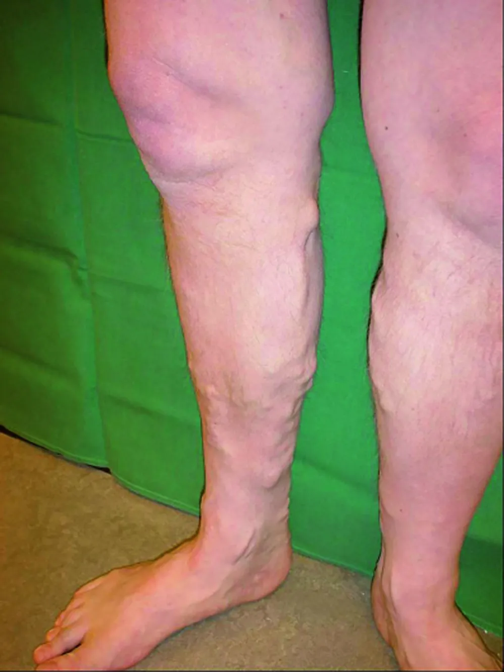 Varices in het stroomgebied van de vena saphena magna, beiderzijds